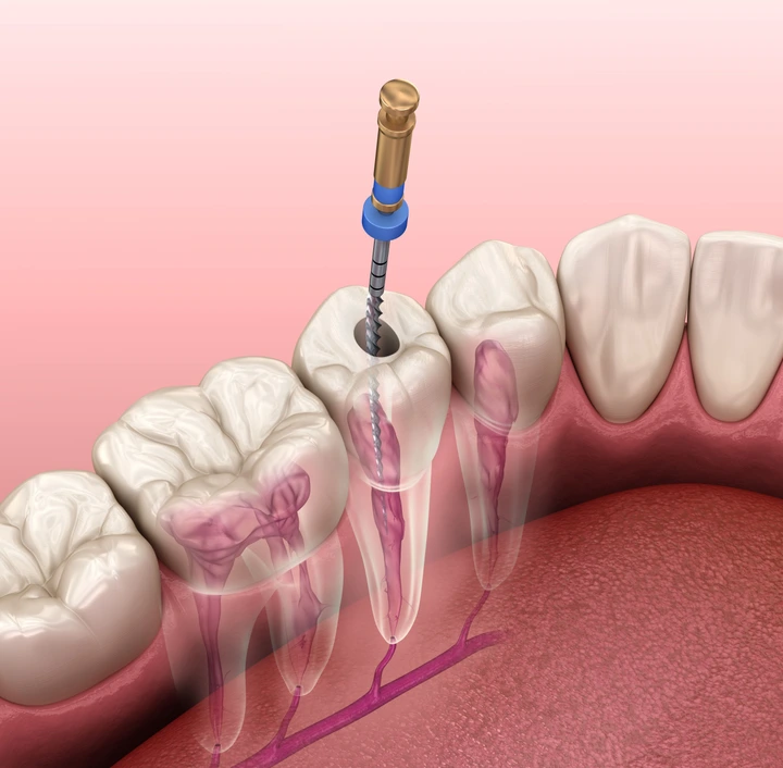 Root Canal | Lotus Dental Clinic