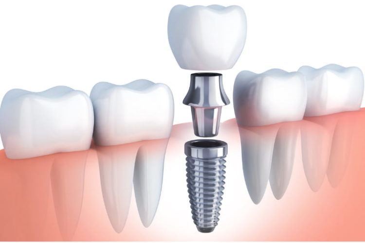 From Start to Finish: Understanding the Dental Implant Process