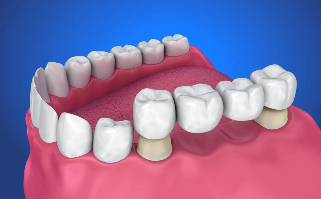 Dental Bridge | Best Dental Care in Kalyan