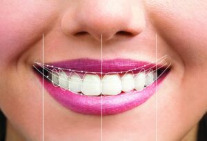 Dental-smile-design_11b3c24a644443f6dba0c9515bfdc463_2000
