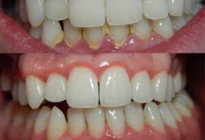 Gingivitis-before-and-after-3-1024x893