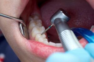 Root-Canal (1)