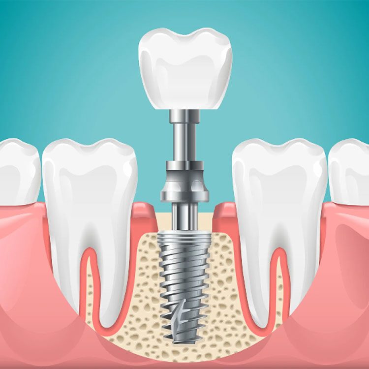 Dental Implants | Lotus Dental Care