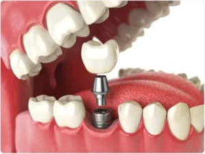 From Start to Finish: Understanding the Dental Implant Process