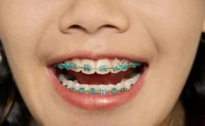 teeth-braces-1296x728-header