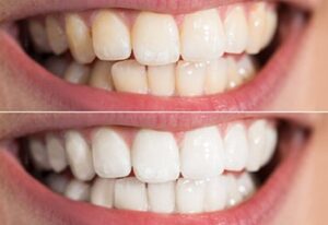 Say Cheese! The Art of Professional Teeth Whitening